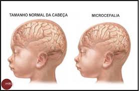 Rondônia:Autoridades de saúde confirmam 1° caso de microcefalia